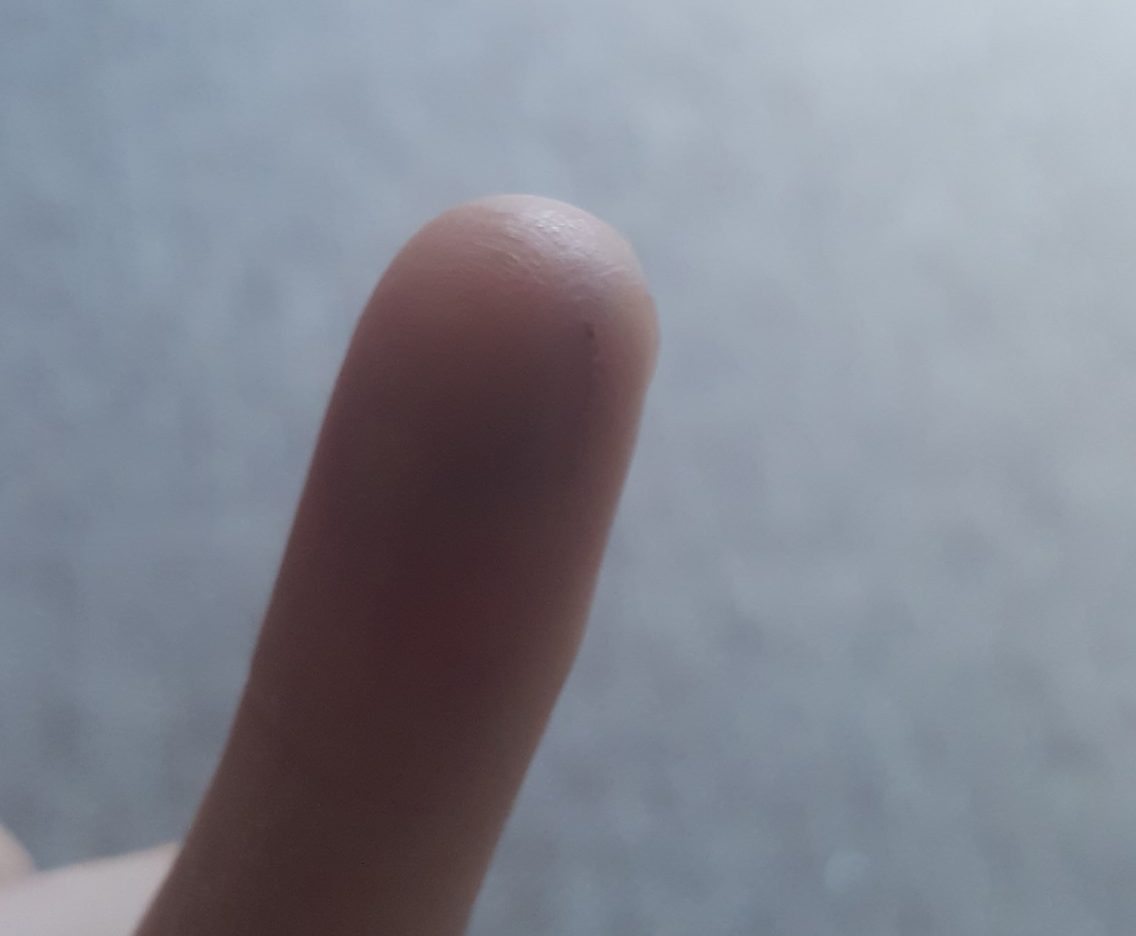 My healed finger with magnet implant